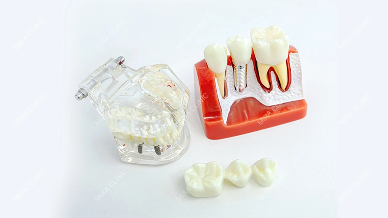 Multi-Unit Abutment